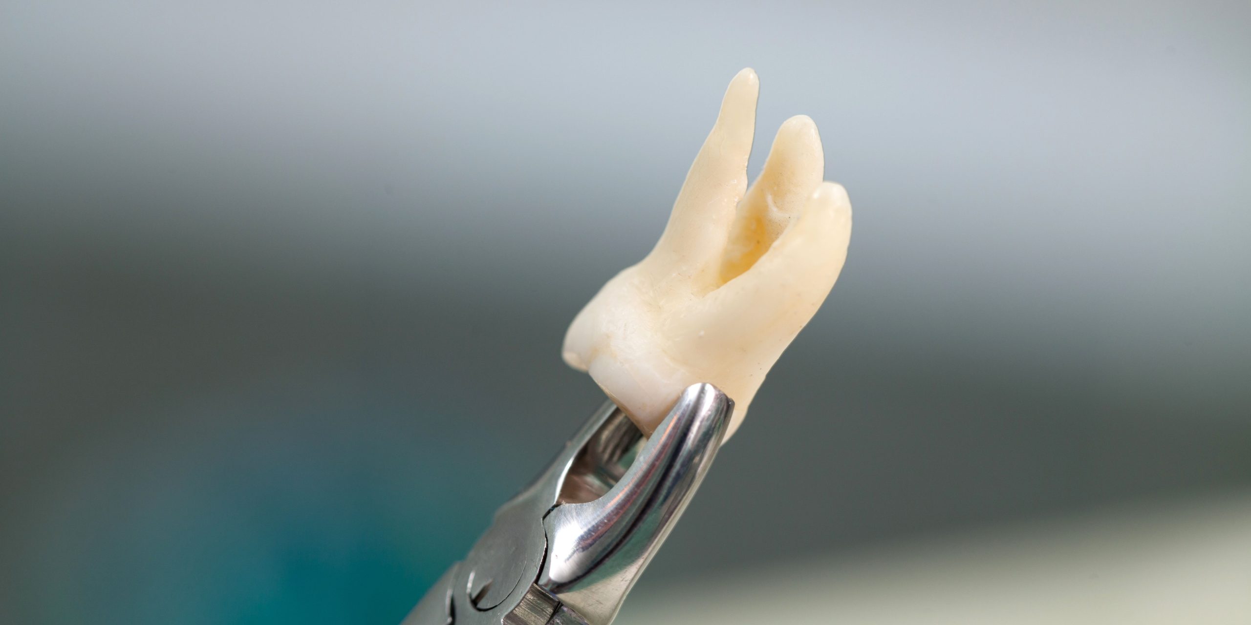 Fractura dental