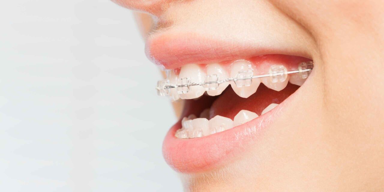 brackets invisibles