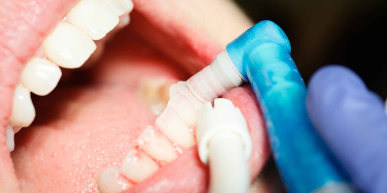 limpieza dental