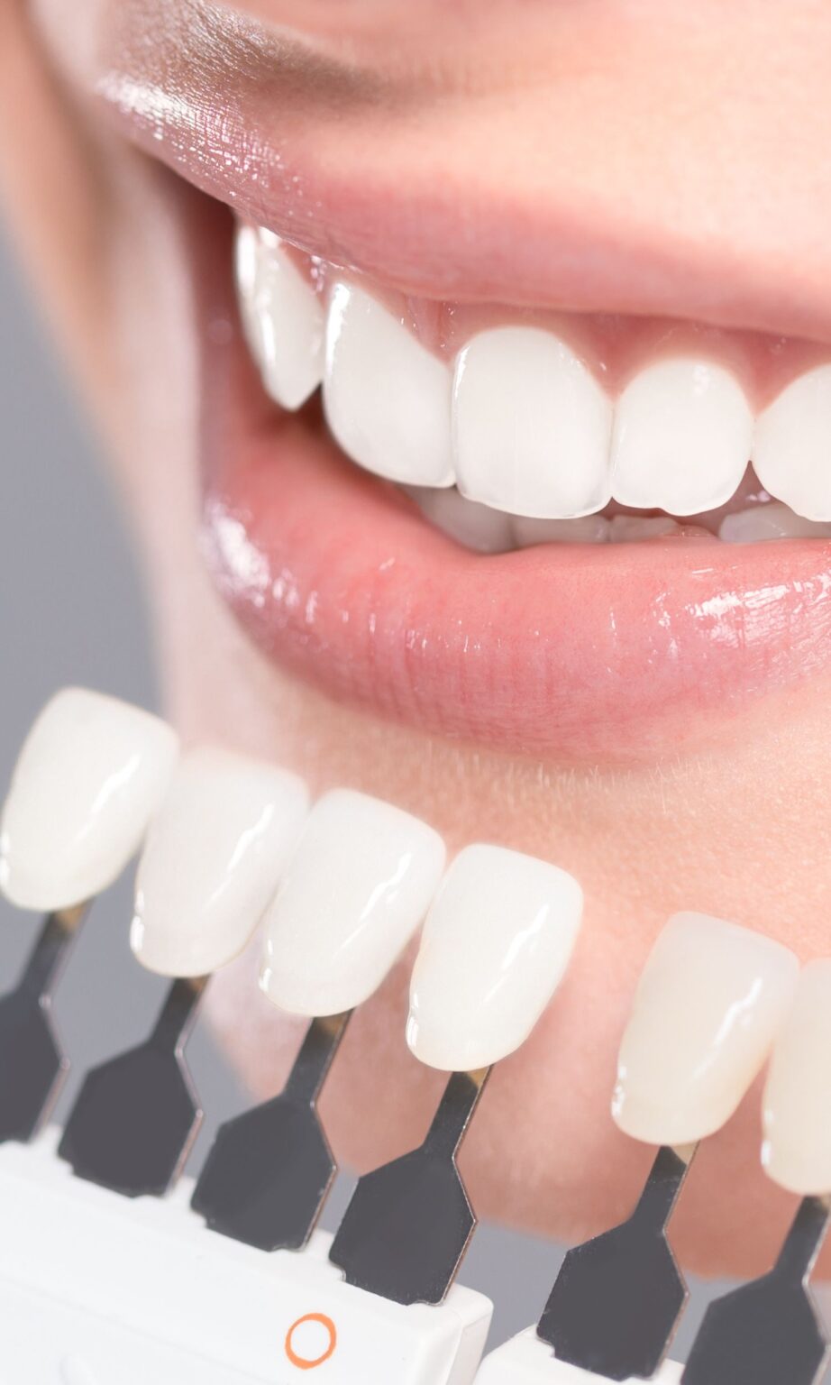 Coronas dentales: todo lo que debes saber - Clínica Kranion