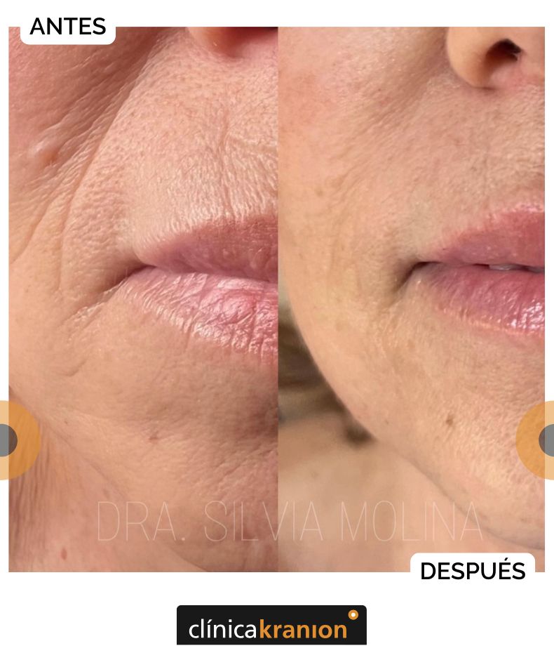 Rejuvenecimiento del Tercio Inferior de la Cara