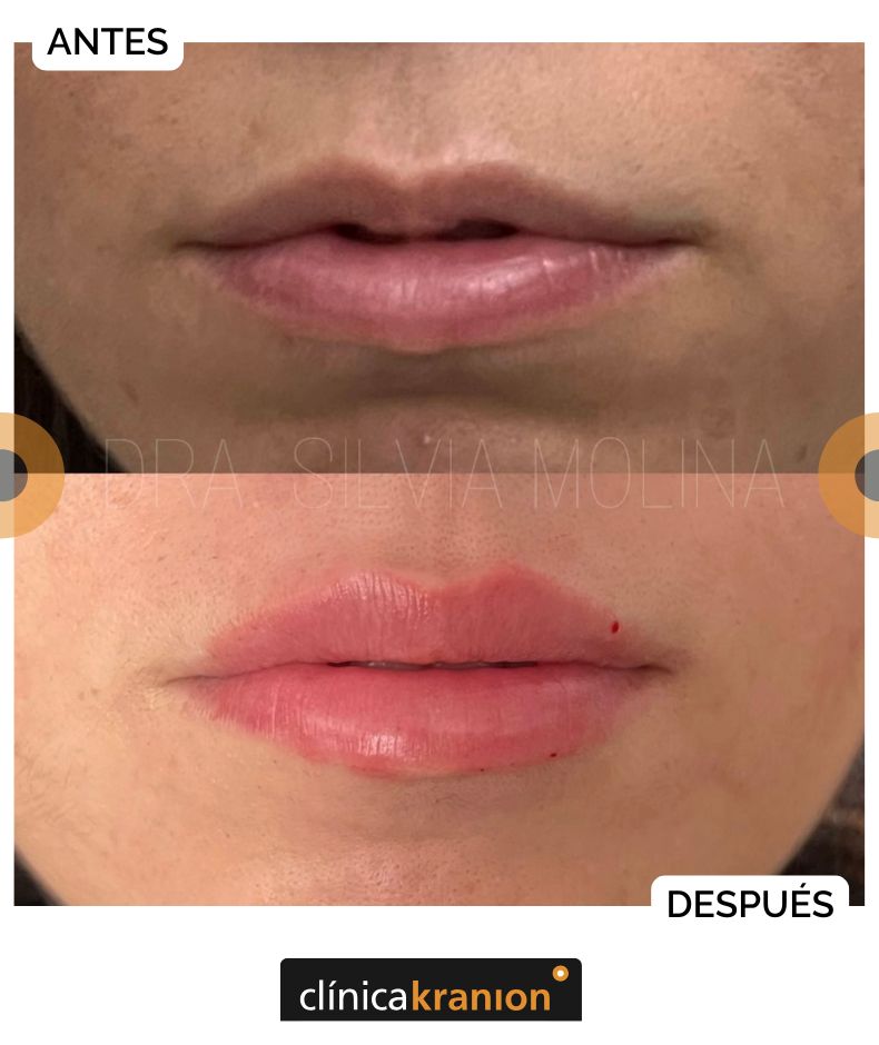 Rejuvenecimiento del Tercio Inferior de la Cara