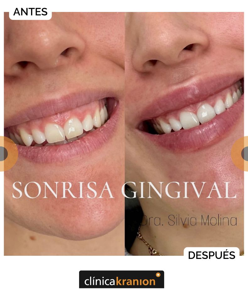 Rejuvenecimiento del Tercio Inferior de la Cara