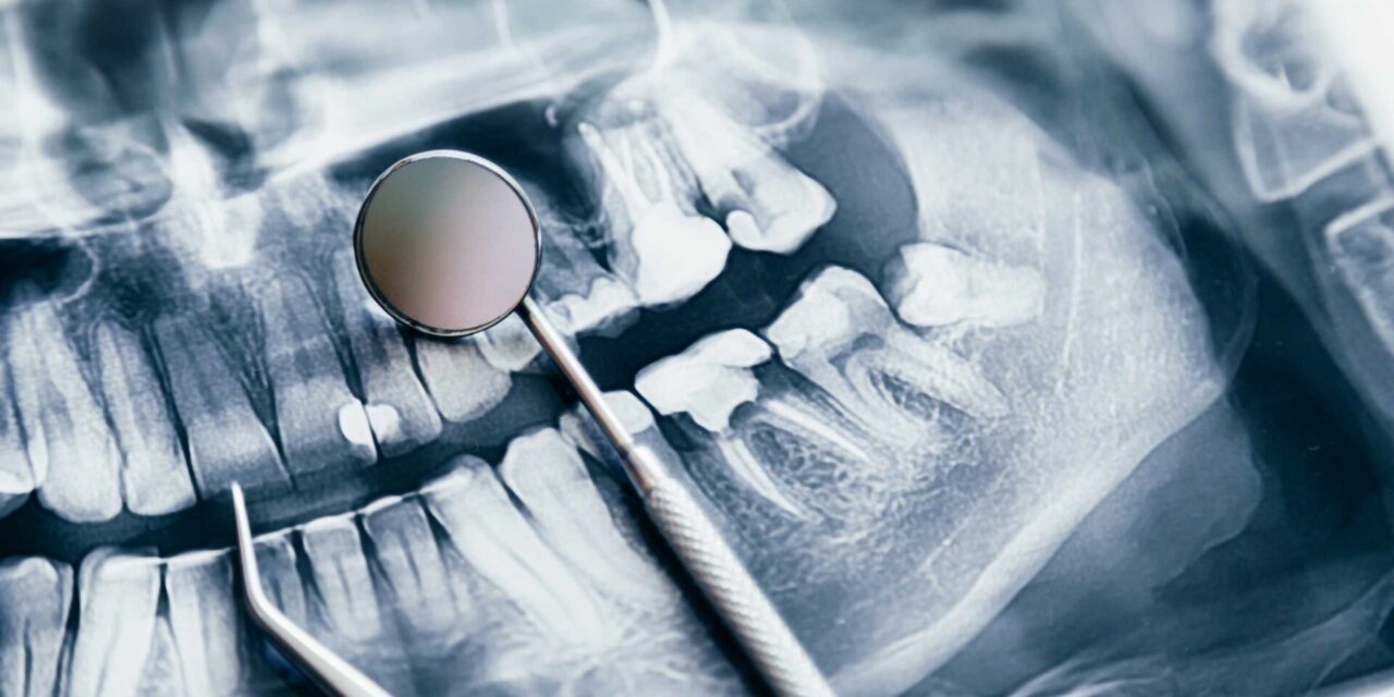 lesión dental