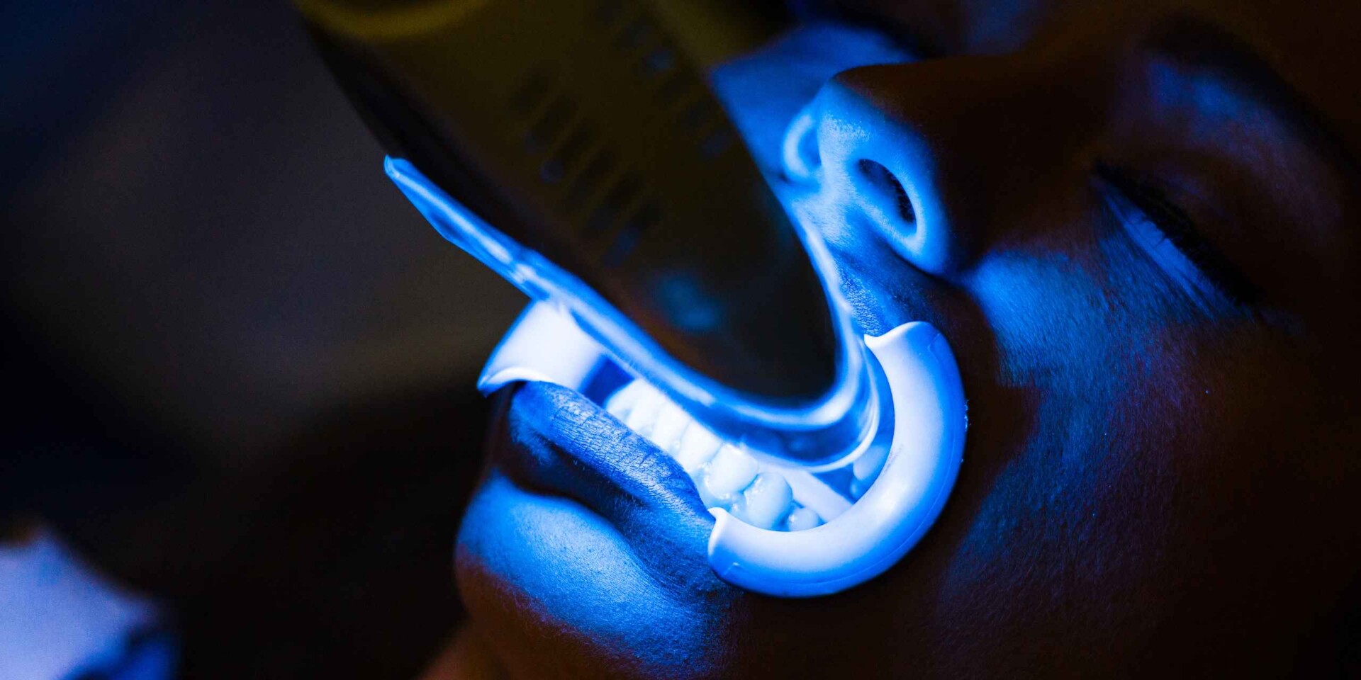 blanqueamiento dental