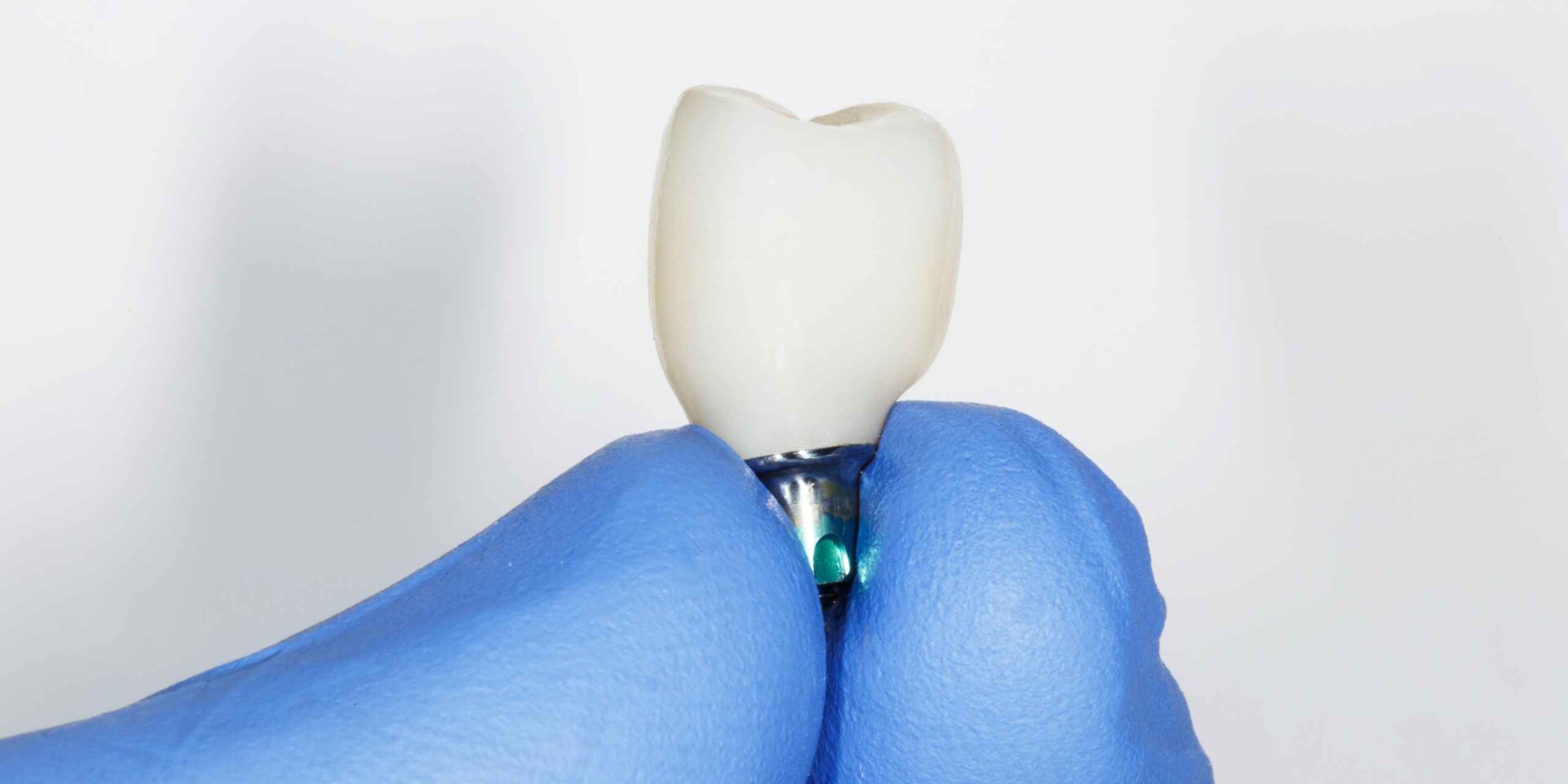 implantes dentales