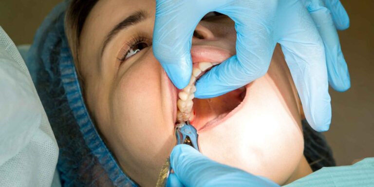 ¿Cuánto tarda en sanar una extracción dental? - Clínica Kranion