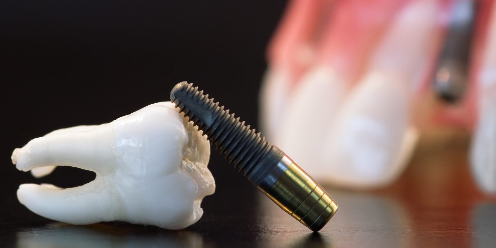 implantes dentales