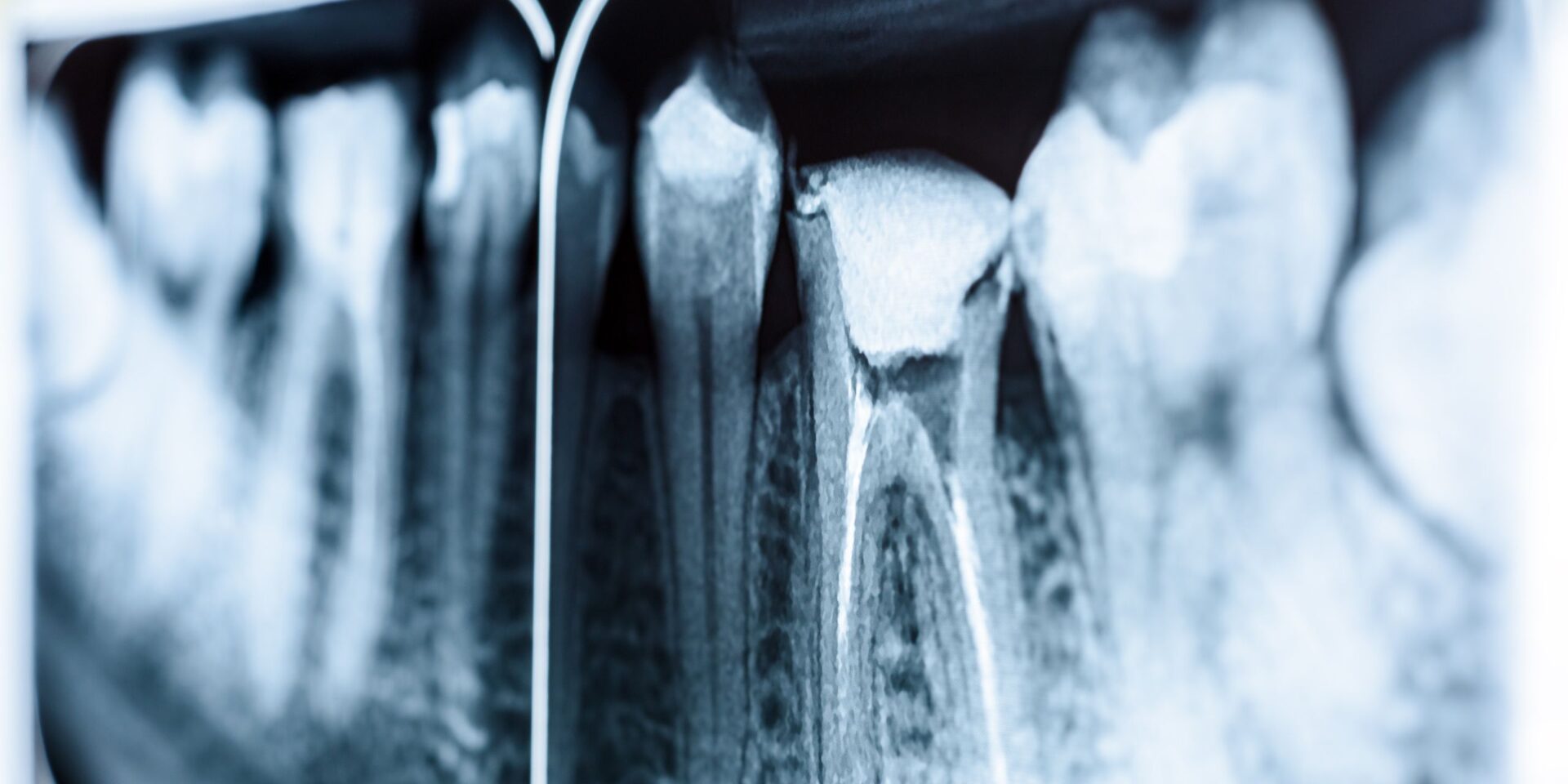 endodoncia