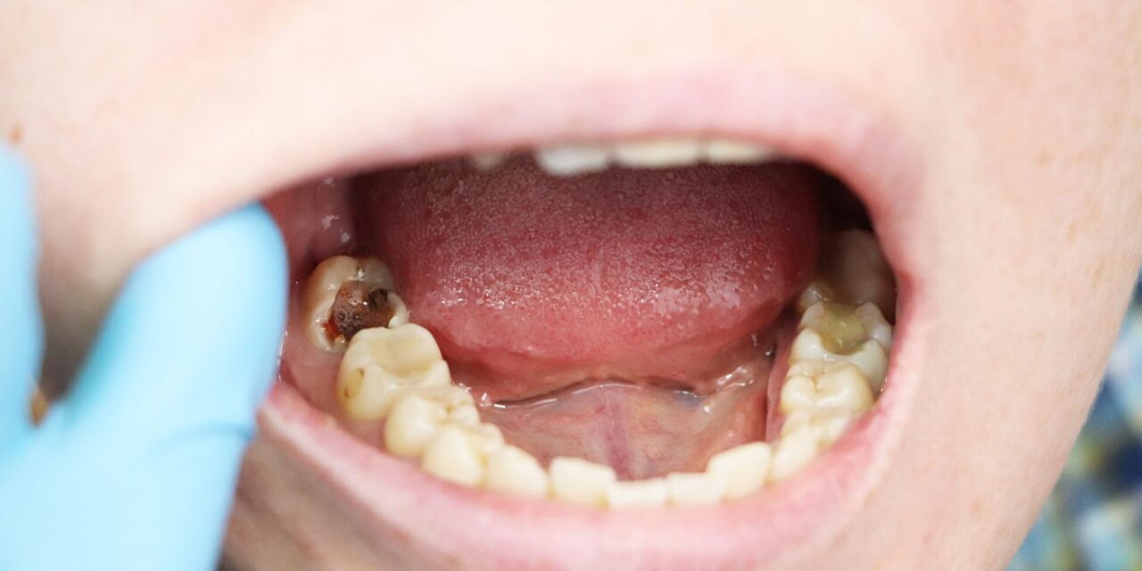 endodoncia