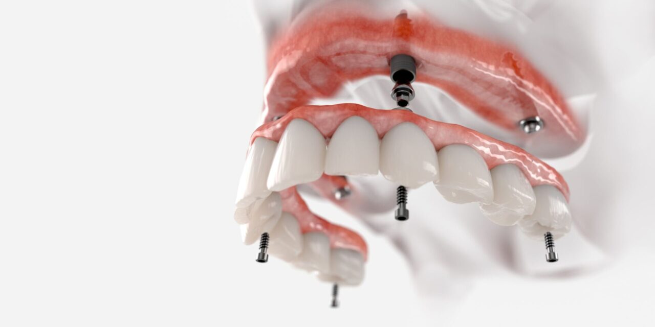 implantes dentales