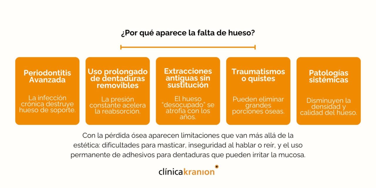 Implantes dentales