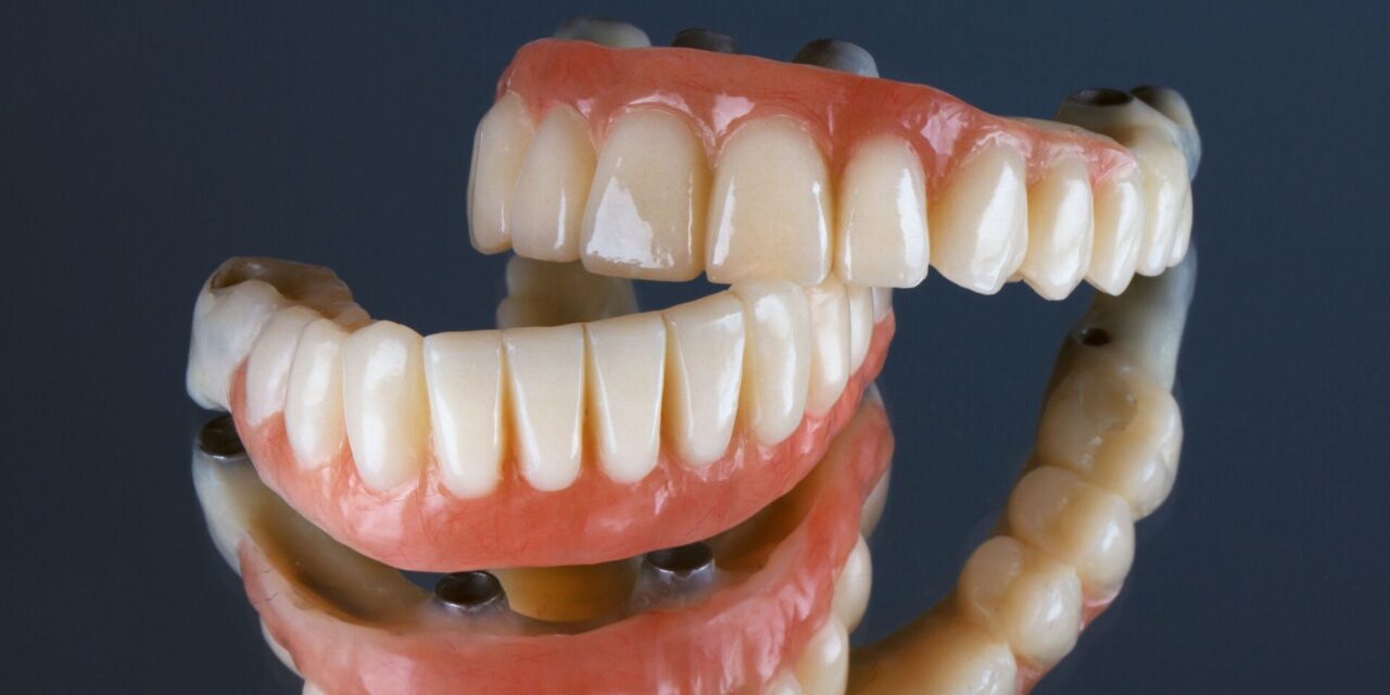 implantes dentales