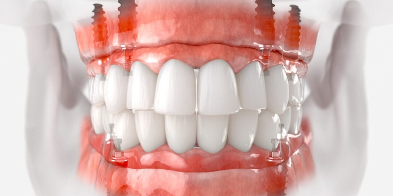 implantes dentales
