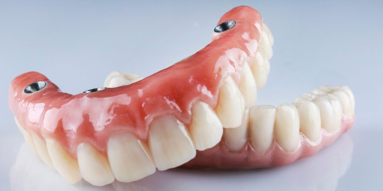 Implantes dentales
