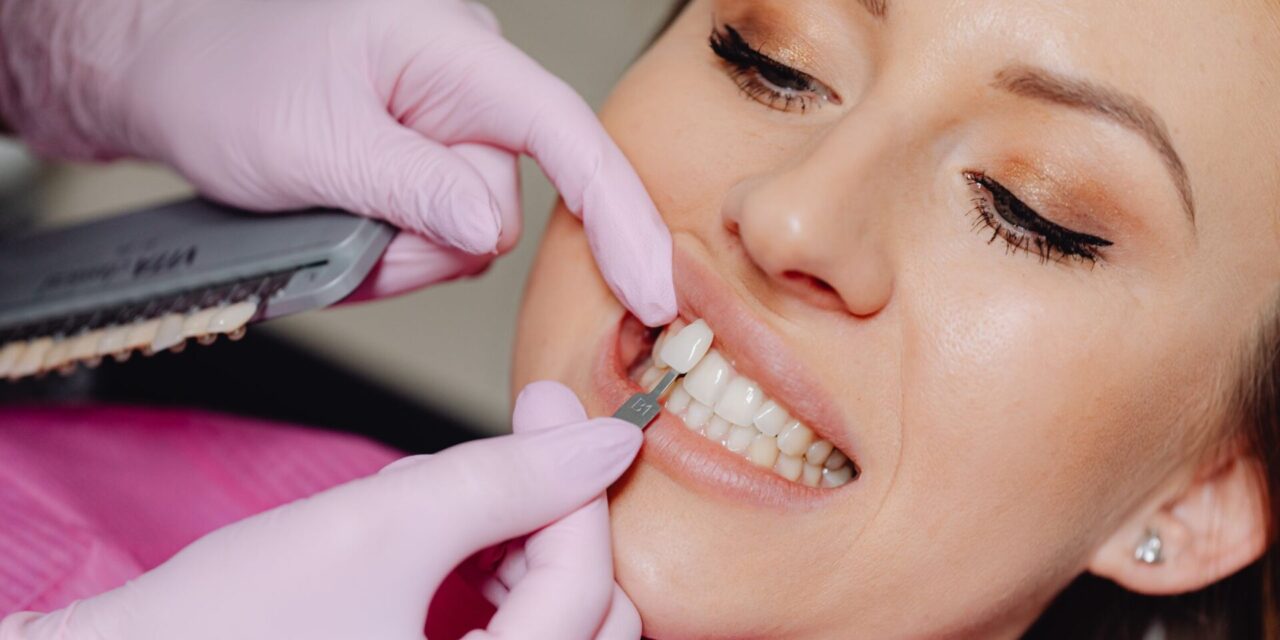 Carillas dentales