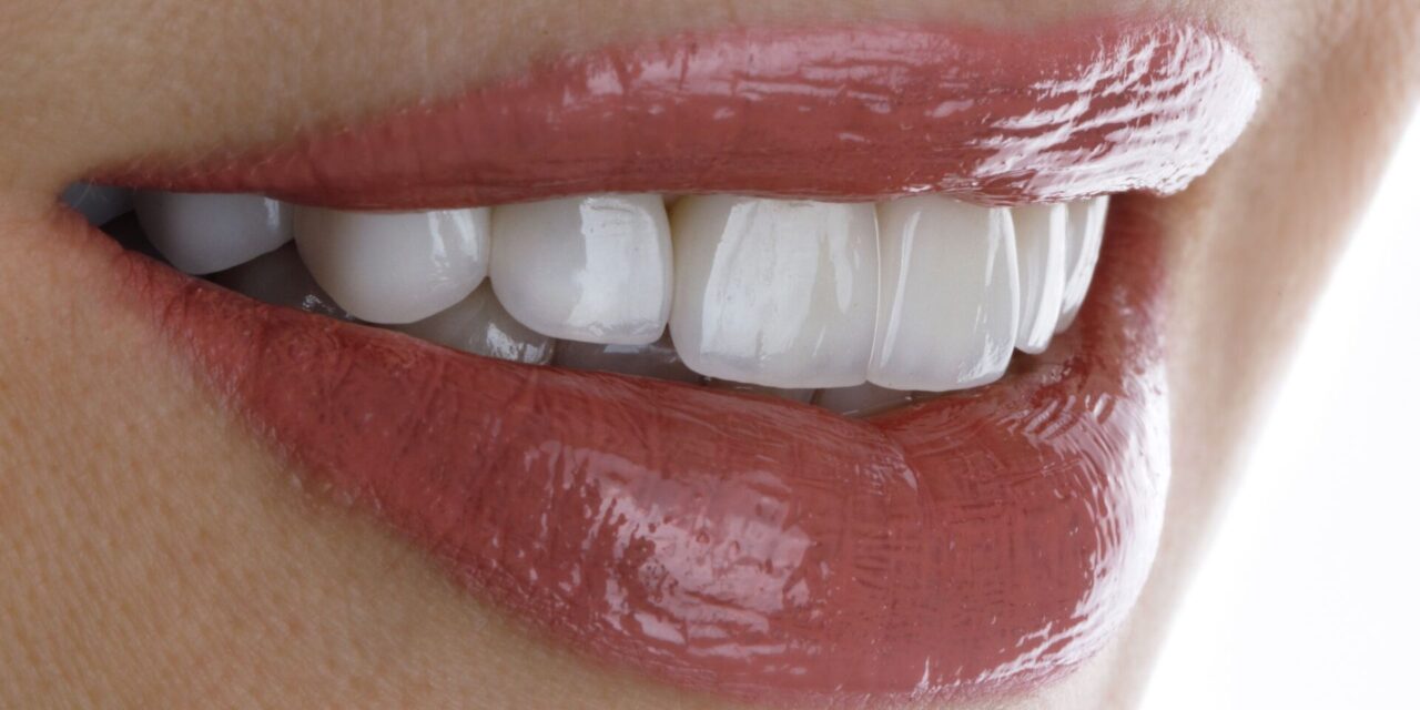 Carillas dentales