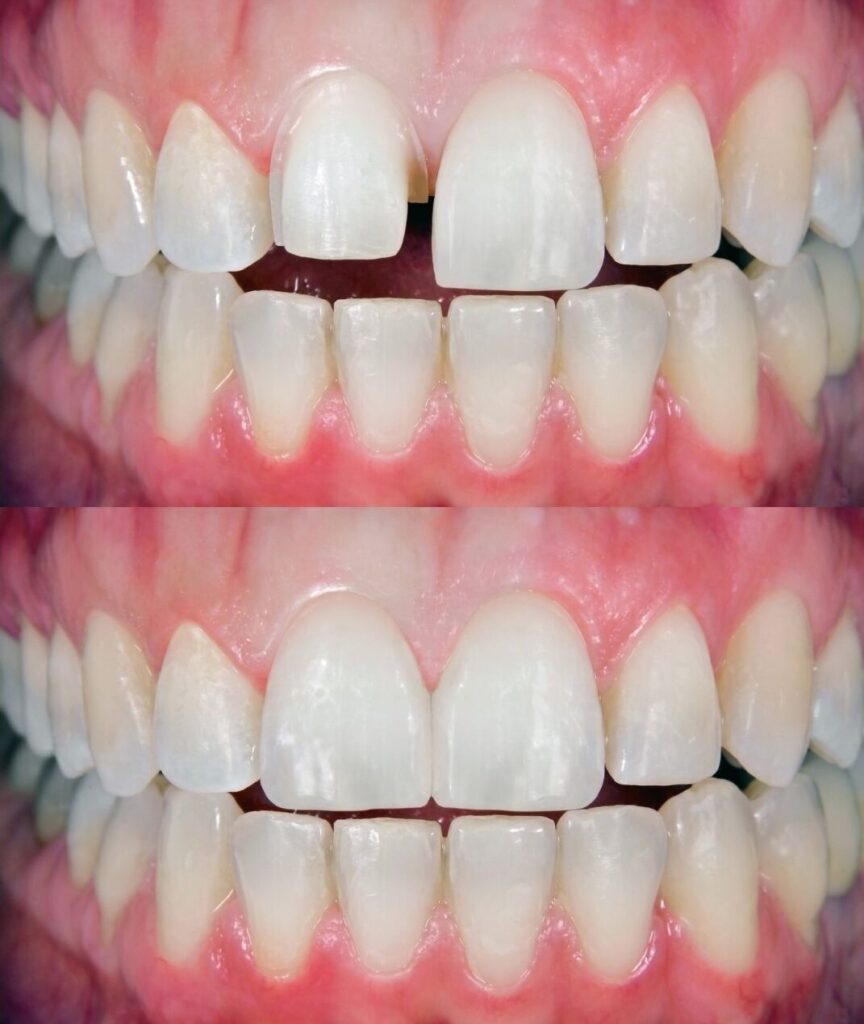 Carillas dentales