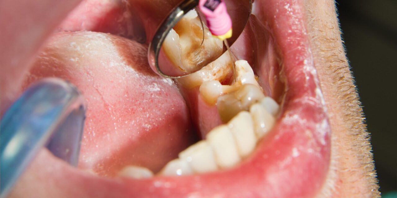 Tratamiento de conducto. Endodoncia en Alicante