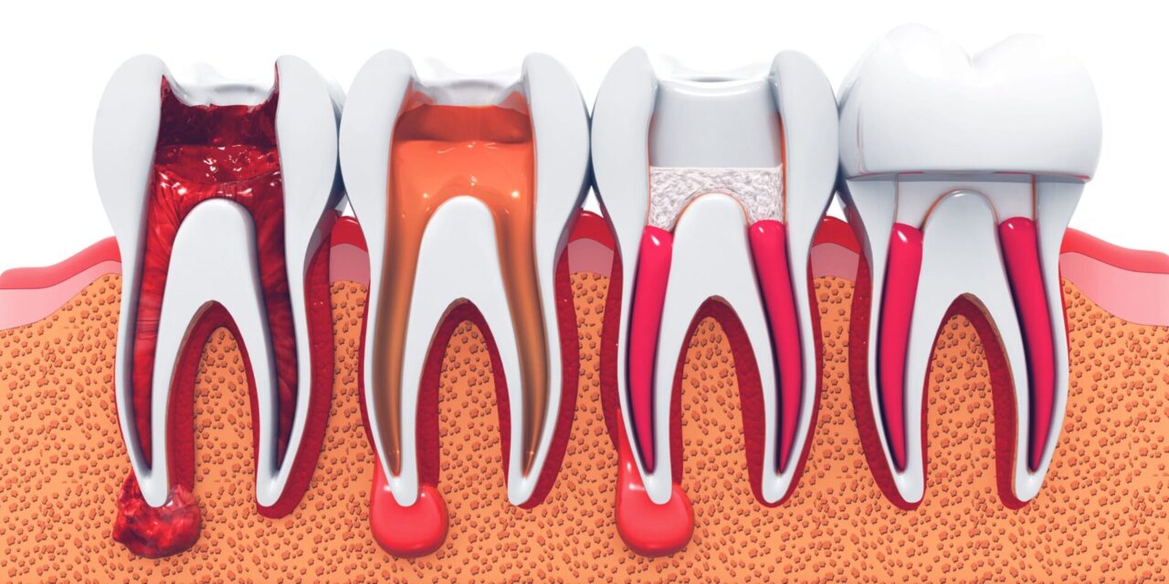 Tratamiento de conducto. Endodoncia en Alicante
