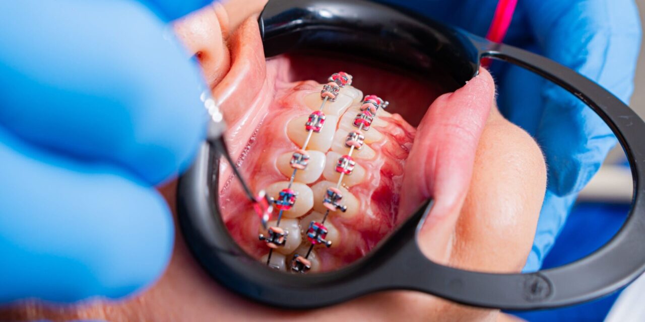 brackets invisibles