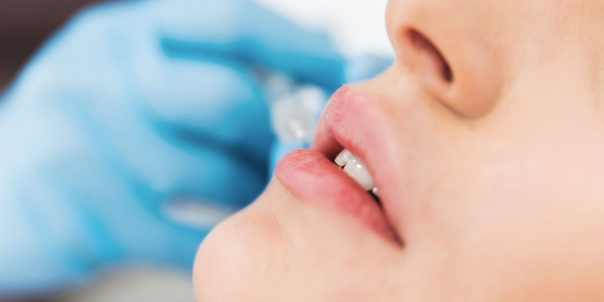 Ácido Hialurónico Labios