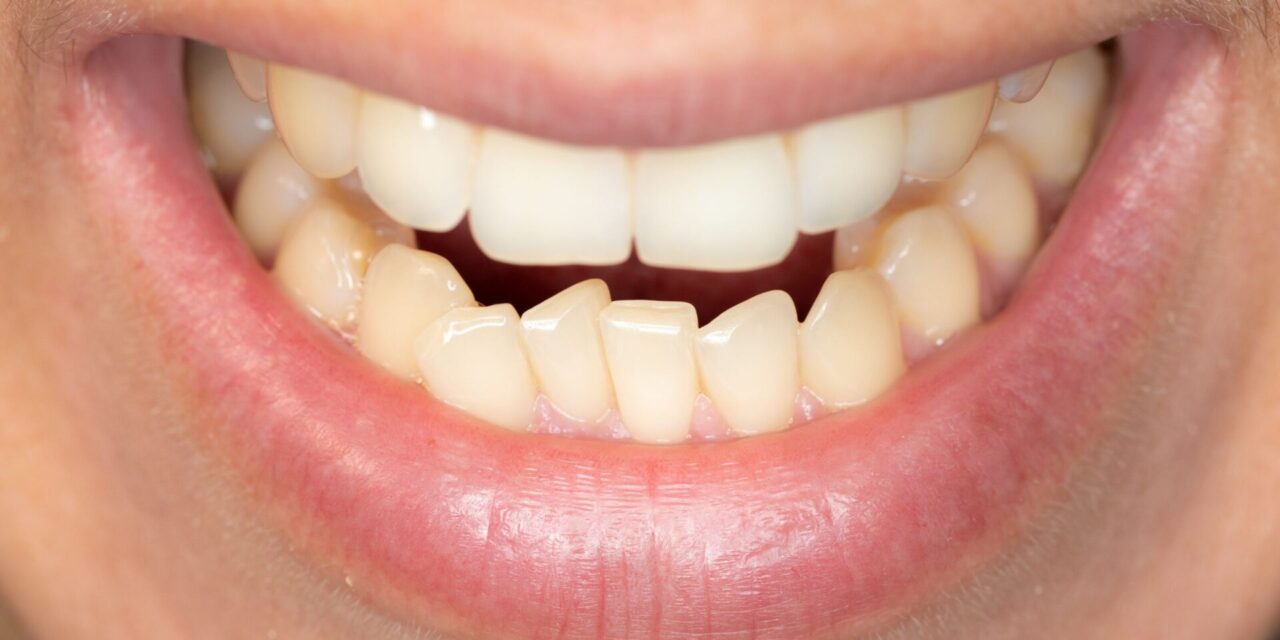 maloclusión dental