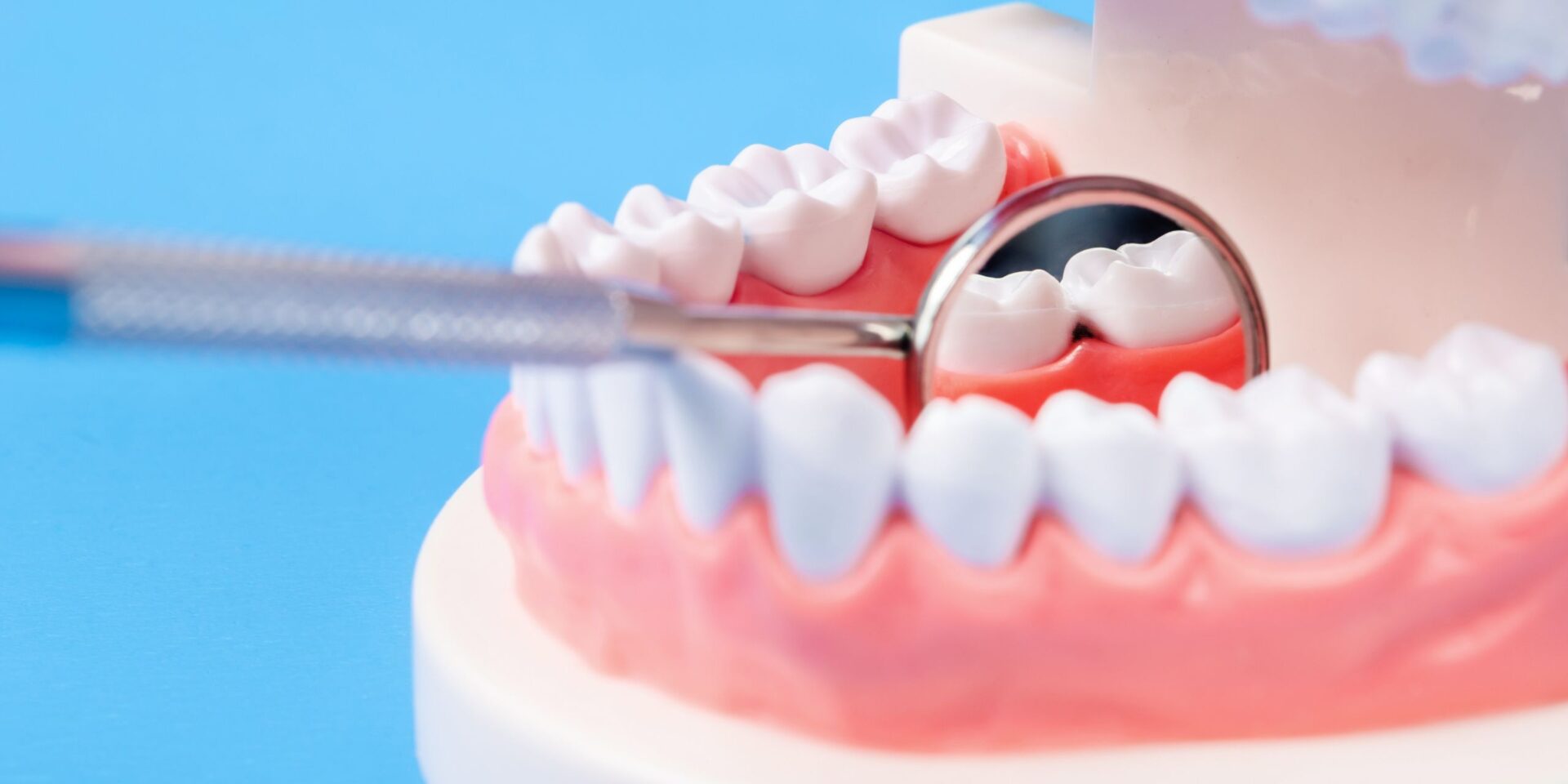 caries