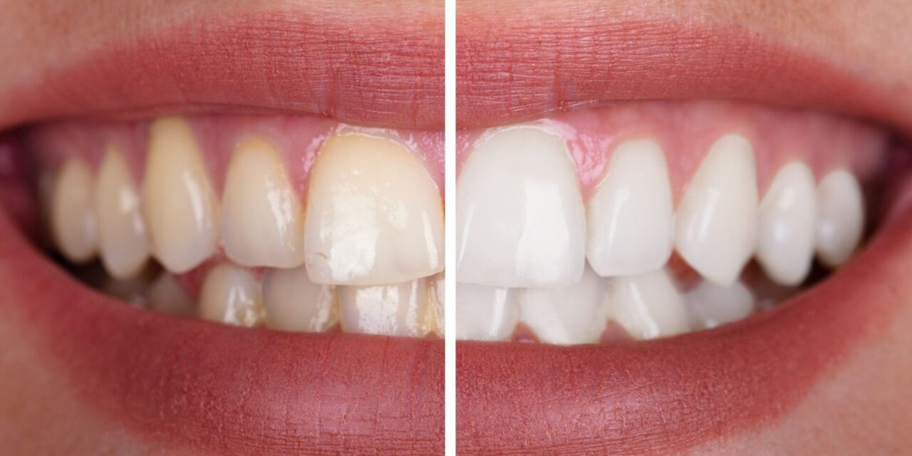envejecimiento dental