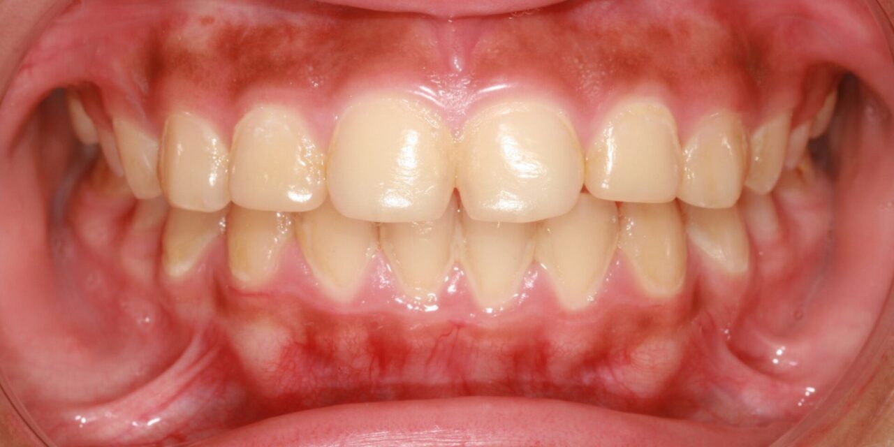 envejecimiento dental