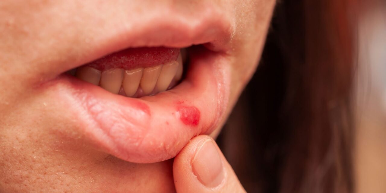 llagas en la boca