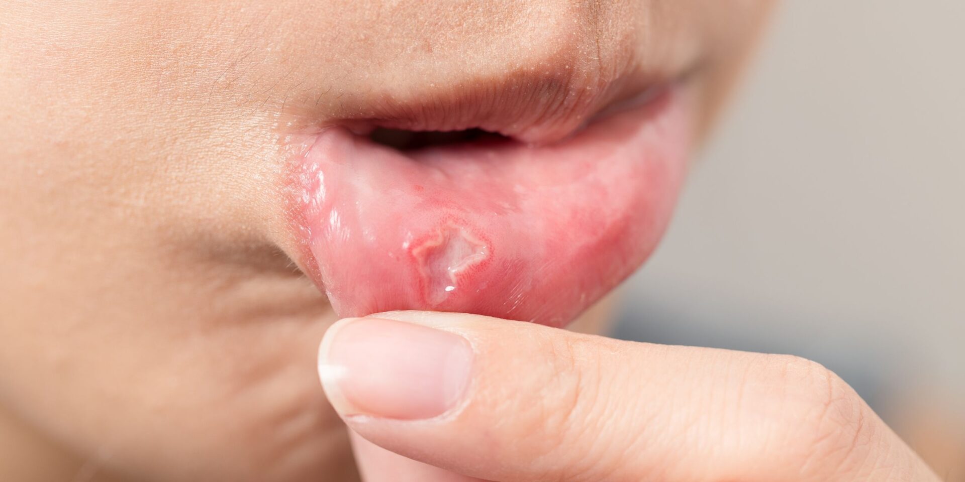llagas en la boca
