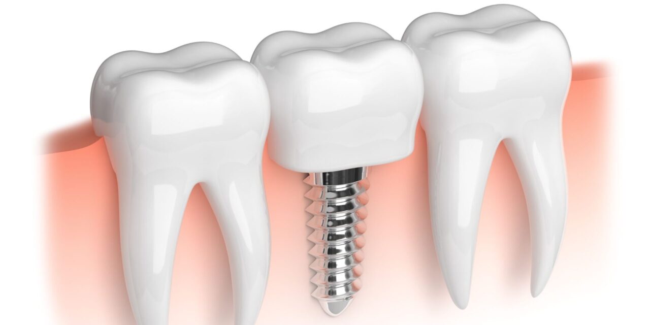 implantes dentales