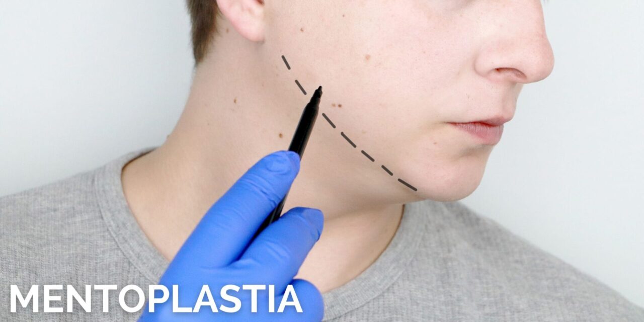 MENTOPLASTIA