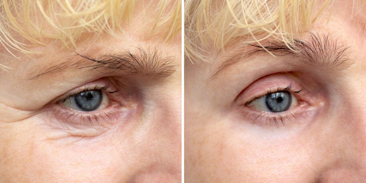 Blefaroplastia superior