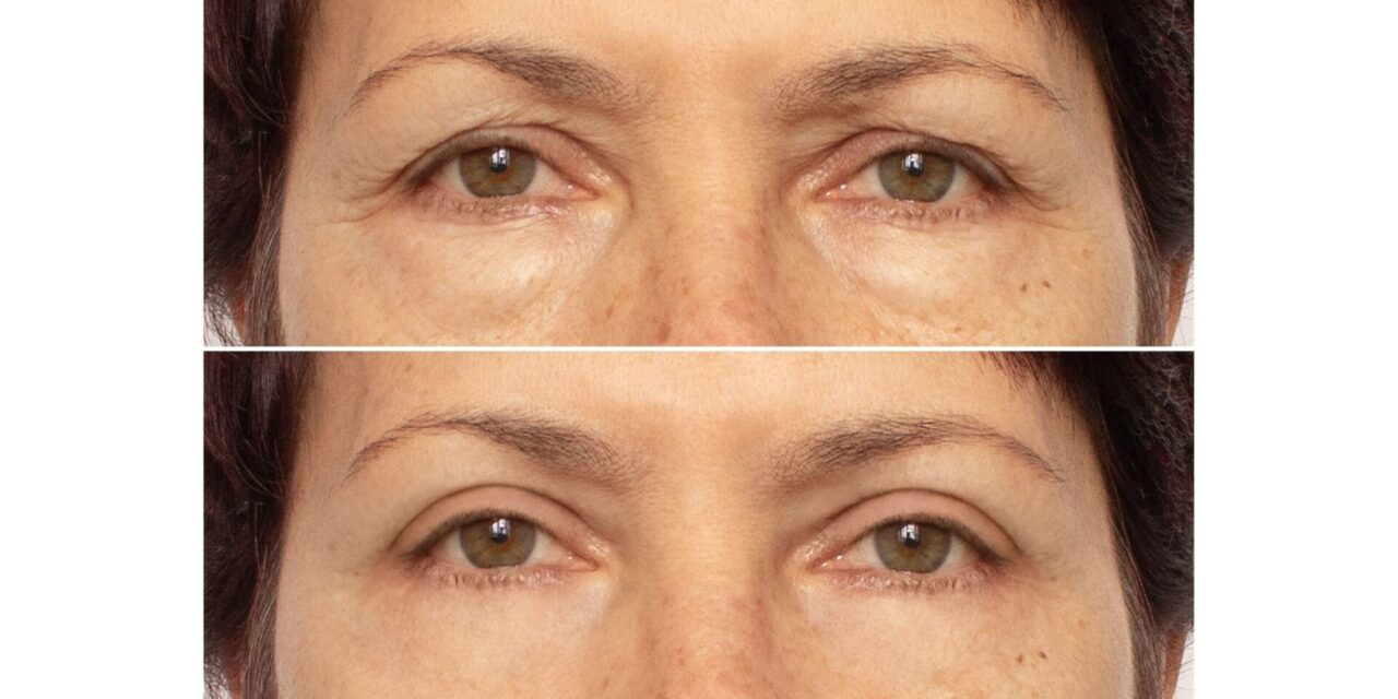 Blefaroplastia Inferior