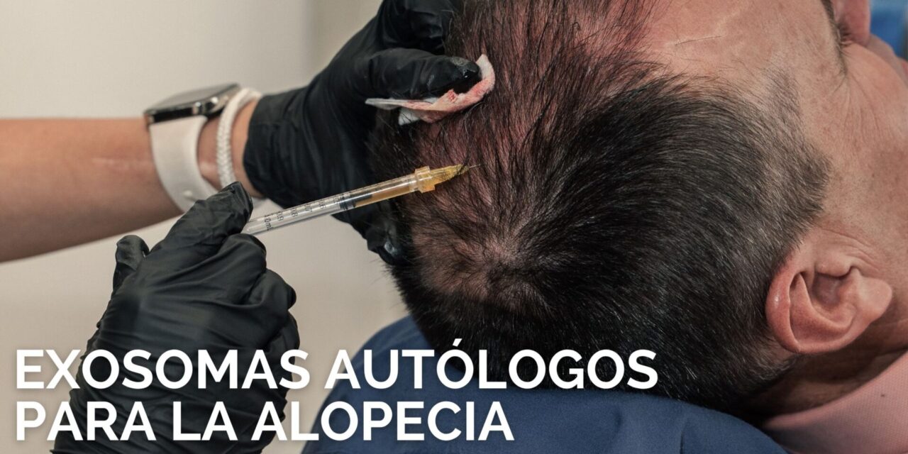 exosomas autólogos para la alopecia