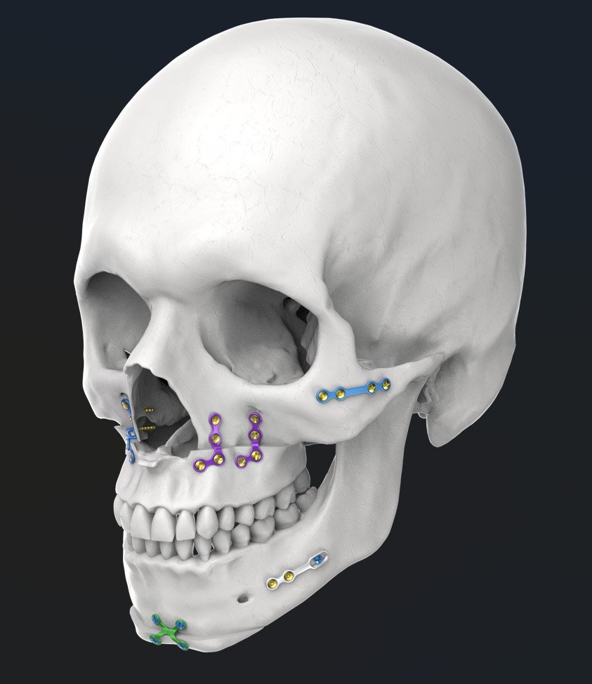 cirugía ortognática