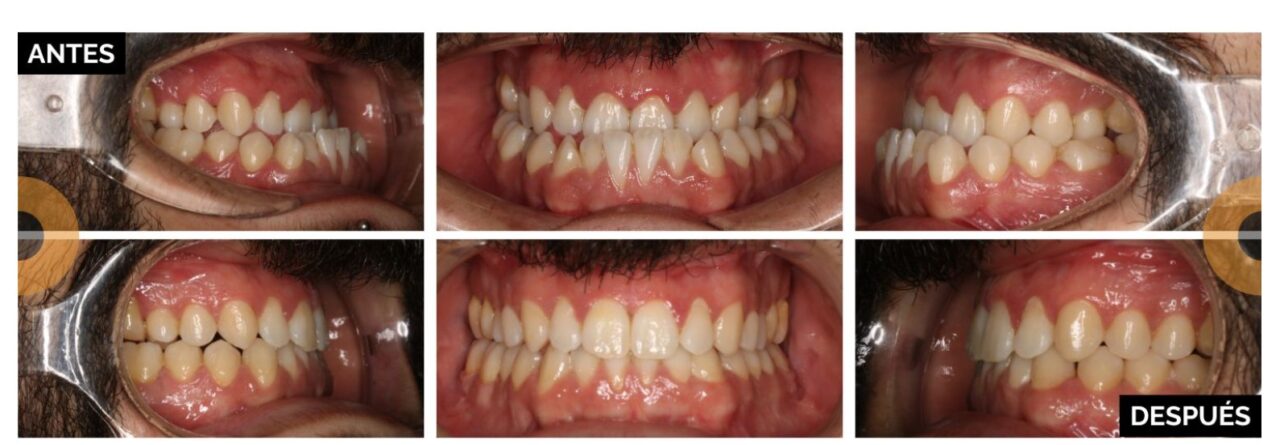 cirugía ortognática