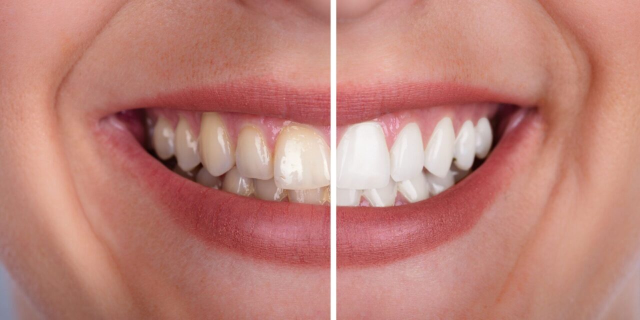 blanqueamiento dental