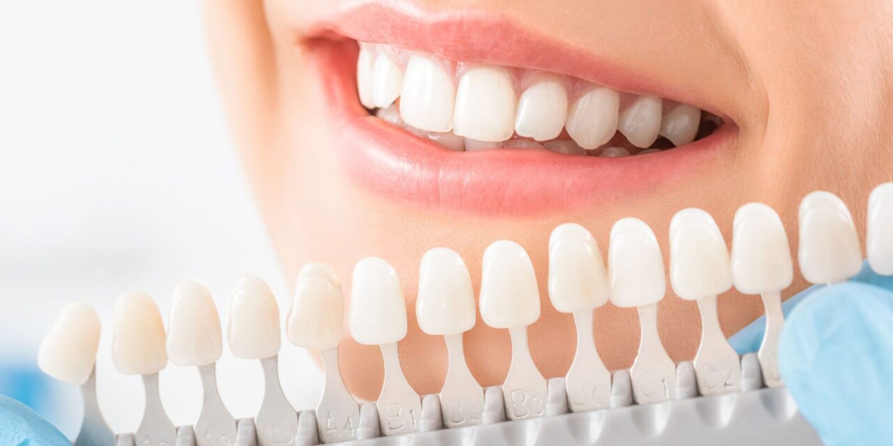 blanqueamiento dental