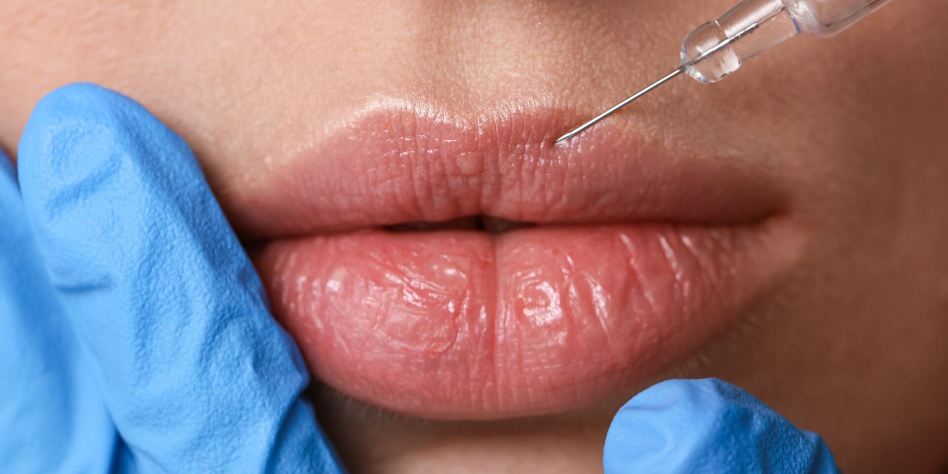 ácido hialurónico labios