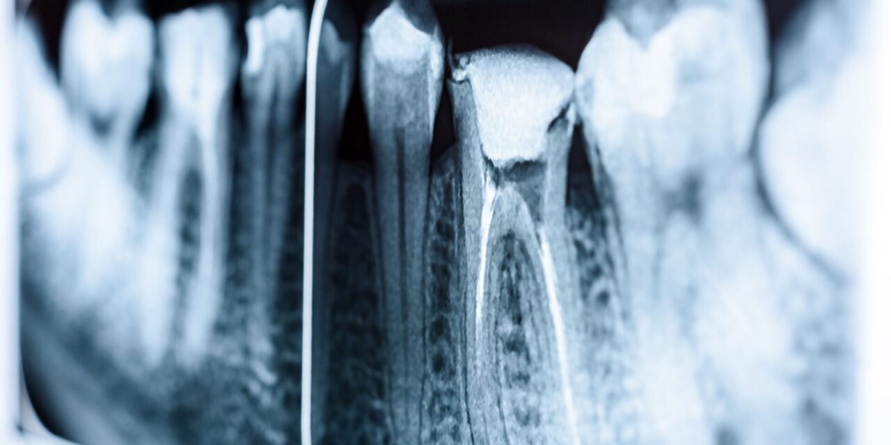 endodoncia