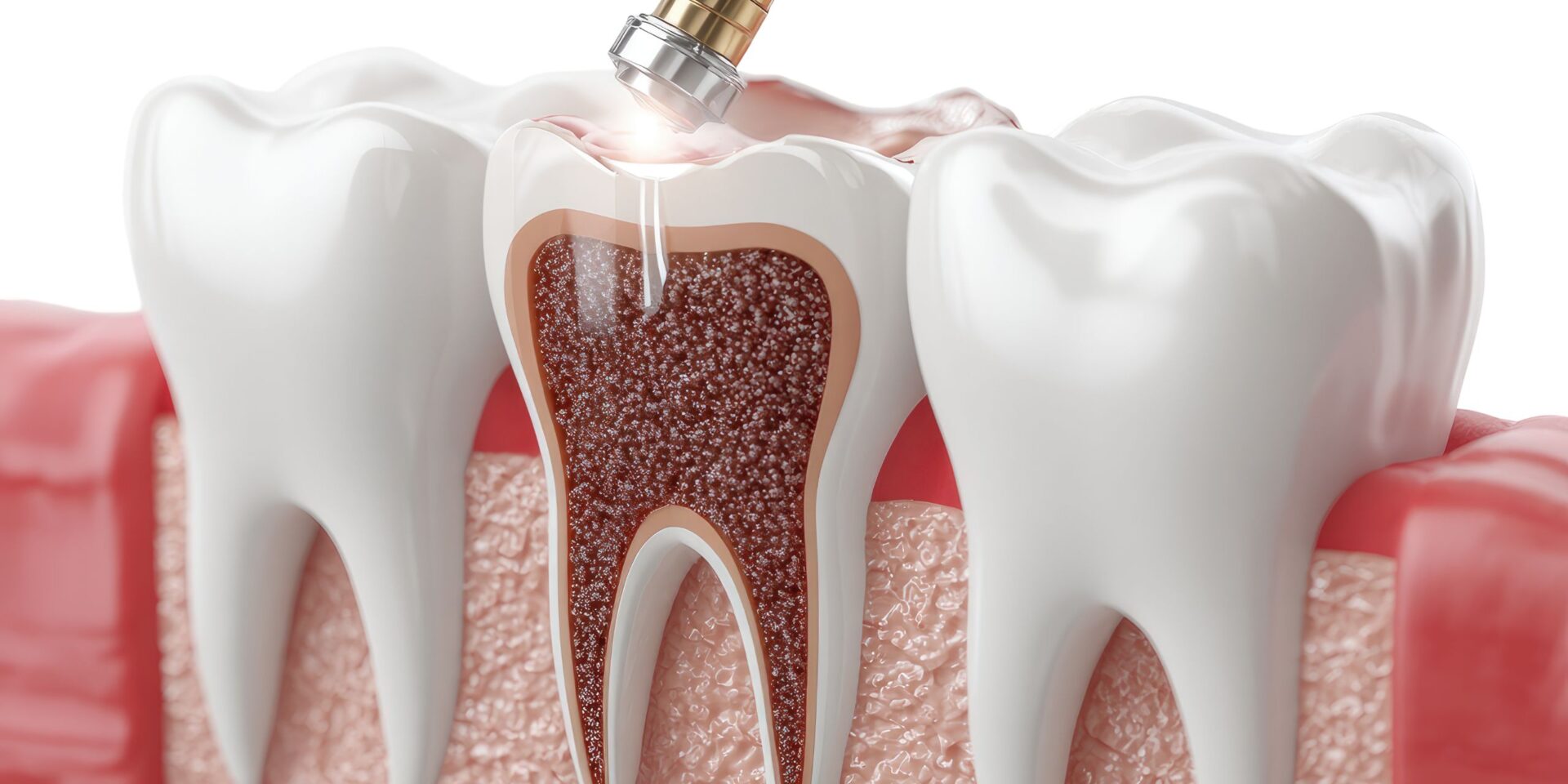endodoncia