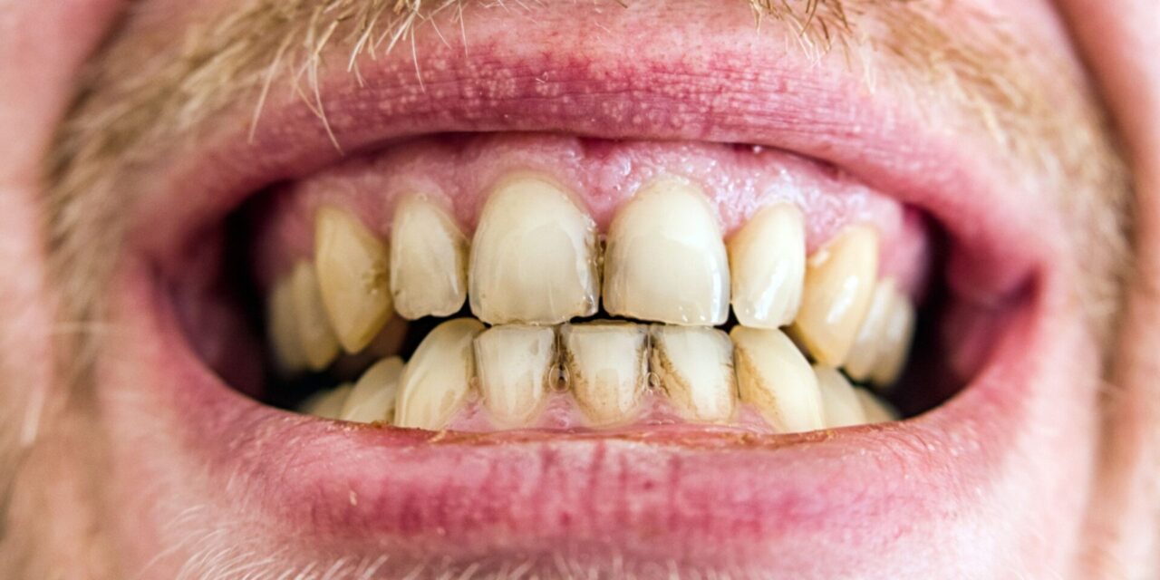 dientes amarillos