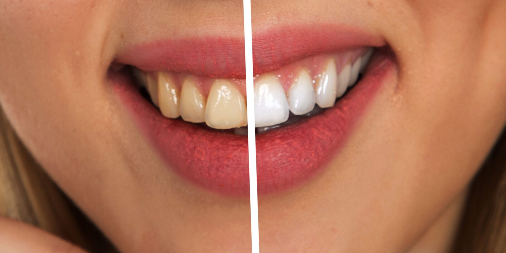dientes amarillos
