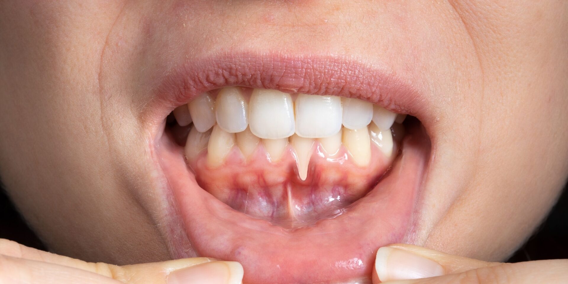Cirugía periodontal