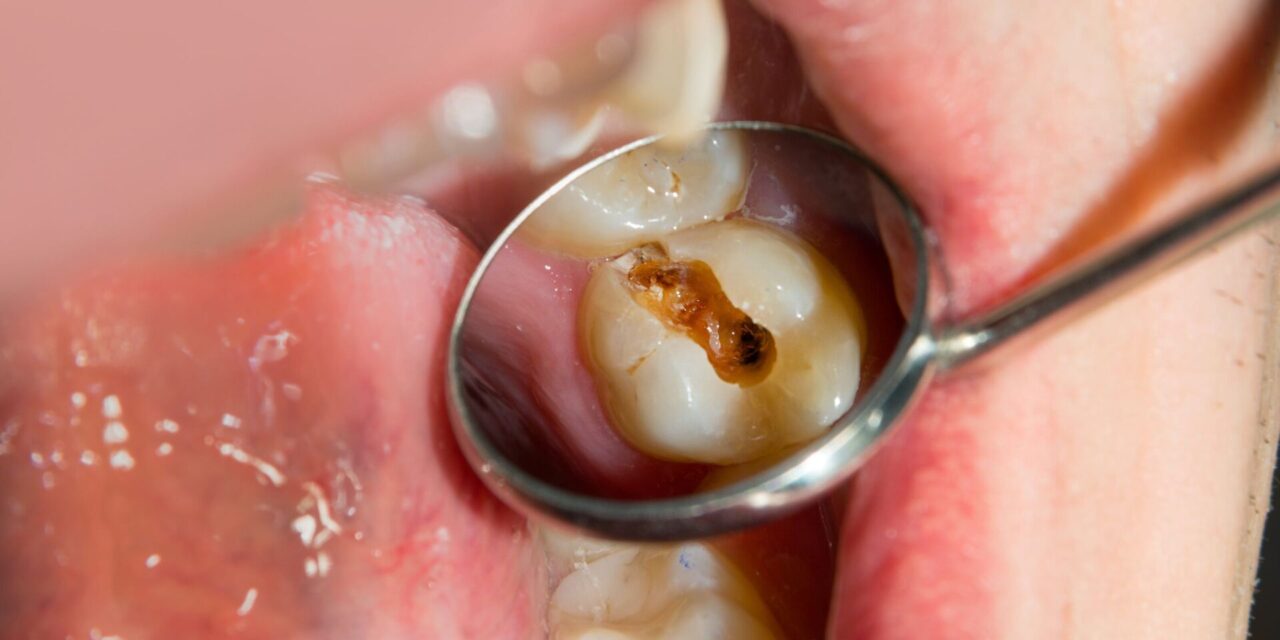 Caries