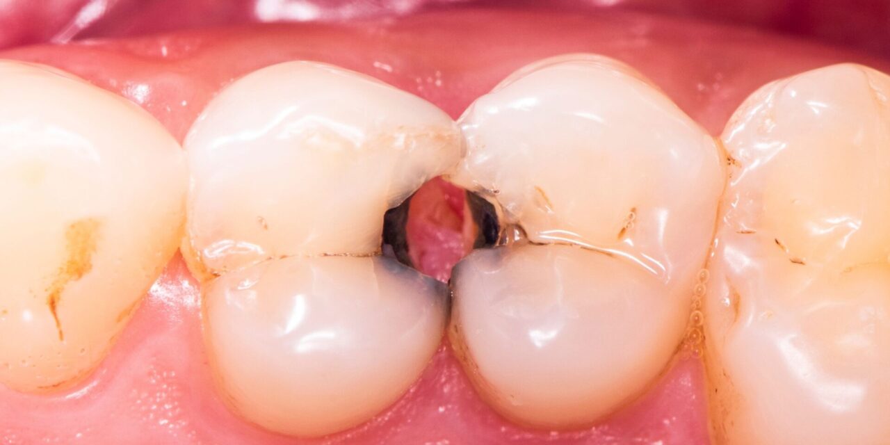 Caries