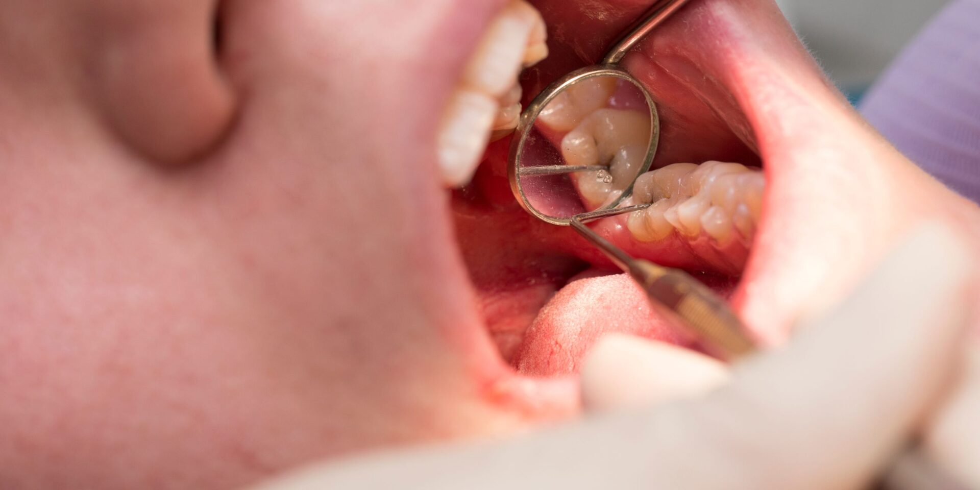 Caries